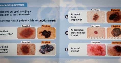Įvairūs odos dariniai: apgamai, papilomos, keratozės