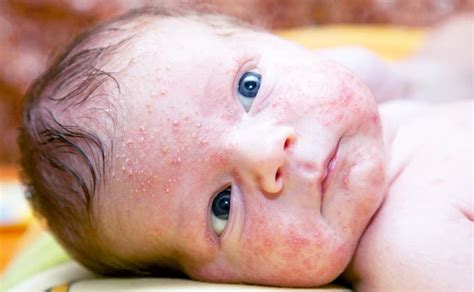 naujagimio odos bėrimai