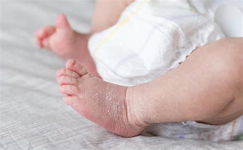 šeši piršteliai ant naujagimio rankos