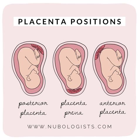 Placenta su virkštele