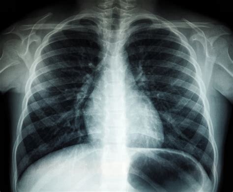 Rentgeno nuotrauka, rodanti inksto stentą