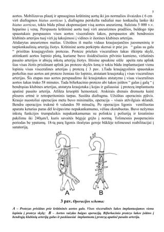 Schema, vaizduojanti pilvo aortos aneurizmą ir jos gydymą protezu