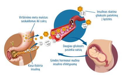 Schematinis nėščiųjų diabeto atsiradimo paaiškinimas