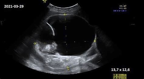 Ultragarsinis vaisiaus tyrimas 5-7 nėštumo savaitę