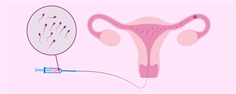 Schema, kaip atliekama intrauterininė inseminacija (IUI)