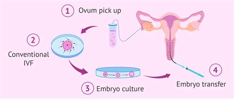 IVF procedūros schema