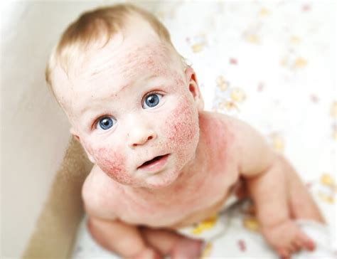 simptomai alerginio dermatito kūdikiams