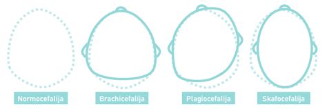 Kūdikio galvos forma plagiocefalijos atveju