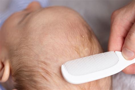 Kūdikio galvos odos vaizdas su pleiskanų luobele