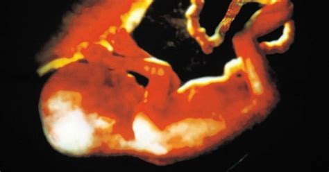 vaisiaus judesiai per pilvo ultragarsą