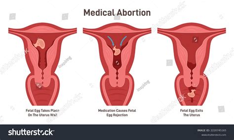 schematic representation of medical abortion procedure