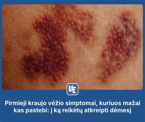 Simptomai, kuriuos palengvina Tavegyl