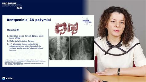 Žarnų nepraeinamumo schema