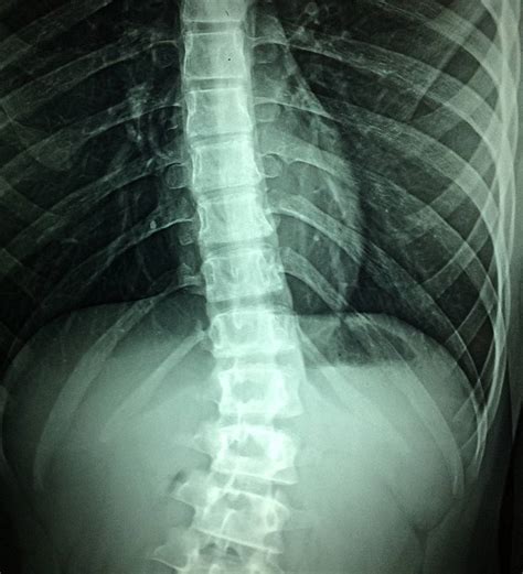 rentgenograma, demonstruojanti stuburo kreivumą
