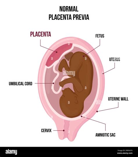 Schema, kaip placenta pritvirtinama gimdoje