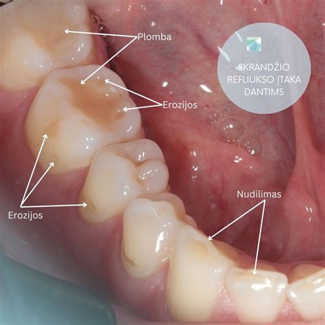 Schema, kaip liežuvis, lūpos ir skruostai veikia dantis