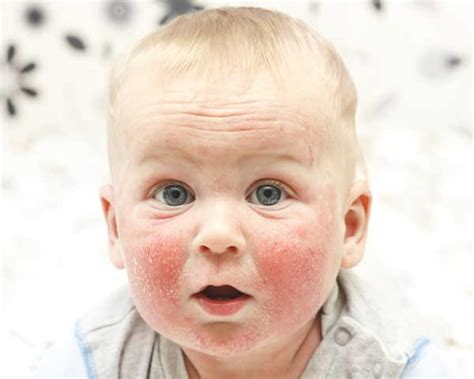 Kūdikio oda su atopiniu dermatitu