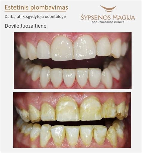 Dantų fluoroze sukeltos dėmės