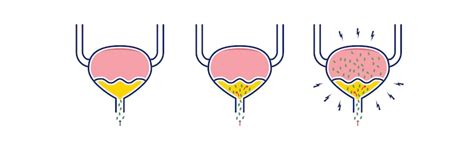 Schema: Šlapimo takų sistema ir galimos infekcijos