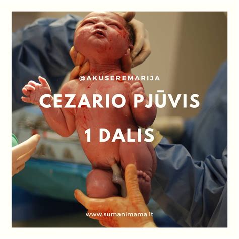 Cezario pjūvio randas laikui bėgant