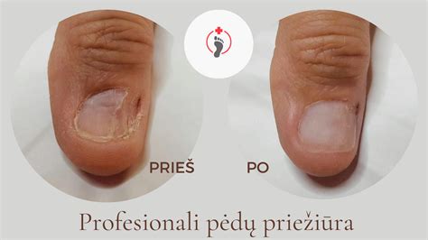 vaikų pėdų priežiūra