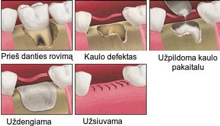 Protinio danties dygimo komplikacijos