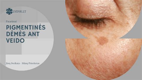 Pavyzdžiai odos pokyčių nėštumo metu (pigmentinės dėmės, strijos)