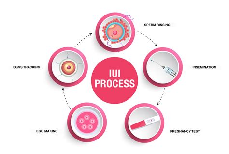 IUI procedūros schema