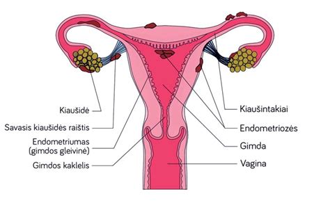 Endometriozės židinių pavaizdavimas