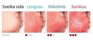 Schematinis atopinio dermatito simptomų vaizdavimas