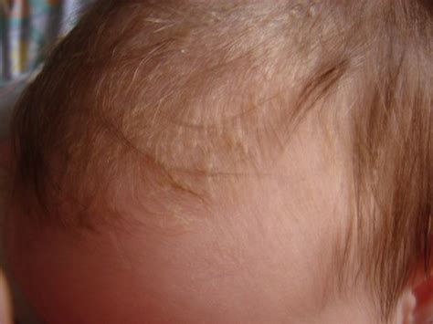 Kūdikio galvytės šašiukų šalinimas