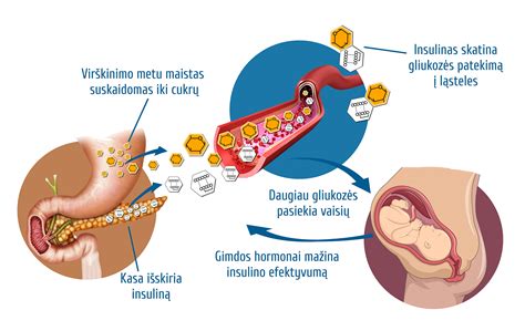 Intrahepatinės nėščiųjų cholestazės simptomai