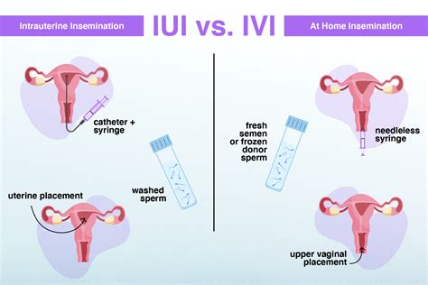 Schema, iliustruojanti intrauterininės inseminacijos (IUI) procesą.