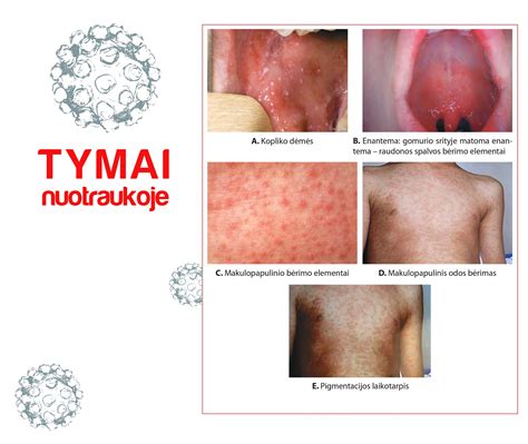 Tipiškas tymų bėrimas ant veido ir kūno