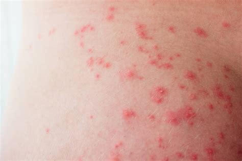 Žiedinis bėrimas ant odos