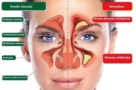 Vaiko nosies gleivinės schema