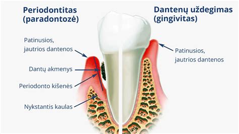 schematinis dantenų uždegimo ir periodontito vaizdavimas
