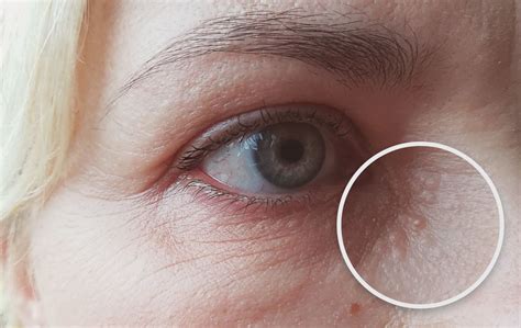 Balti spuogeliai ant kūdikio lūpos