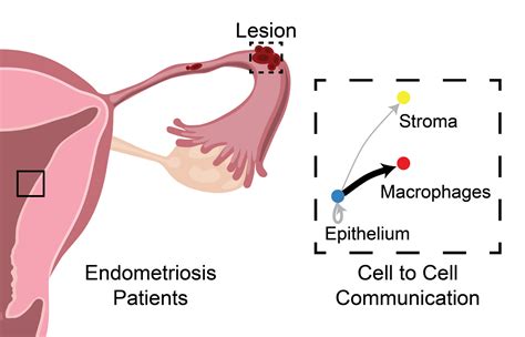 Endometriozės schematinis pavaizdavimas