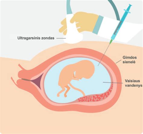 Choriono gaurelių biopsijos ir amniocentezės palyginimas