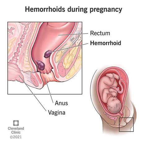 Simptomai ir prevencija hemorojaus nėštumo metu