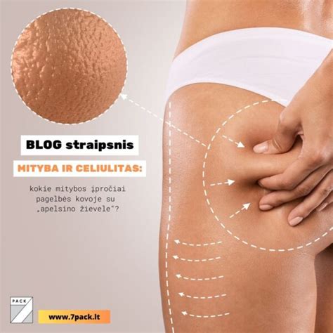 Celiulito pažeista oda, palyginimas su apelsino žievele