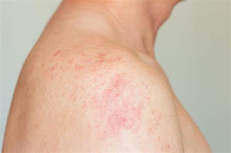 egzema kūdikio odoje