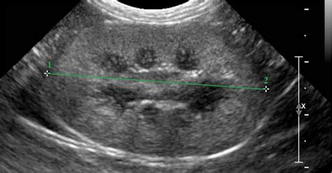 Echoskopijos vaizdas per pilvo sienelę