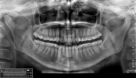 Rentgeno nuotrauka, kurioje matoma odontogeninė cista